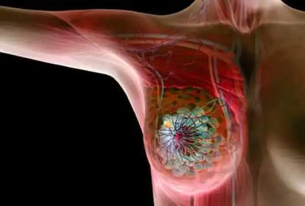 Revealed! The Number of Women Who Die Every Single Day of Breast Cancer Will Shock You